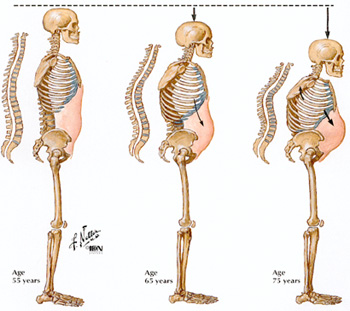 osteoporosis